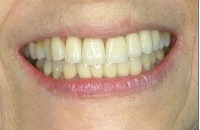 b. porcelain veneers case 2 after