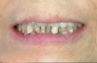 a. porcelain veneers case 2 before