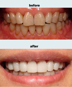 Porcelain veneers case 3