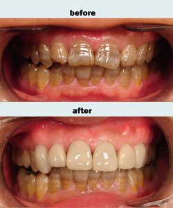 Porcelain veneers case 4 upper only.