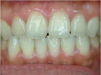 professional bleaching after case1