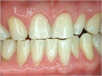 professional bleaching after case2