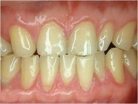 professional bleaching before case2
