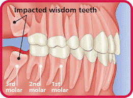 removing wisdom teeth