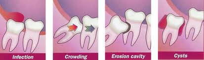 wisdom tooth koo wee rup