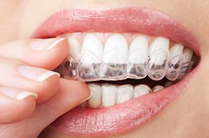 invisalign teeth whitening