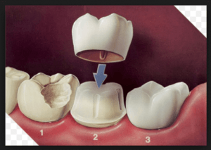 full dental crown