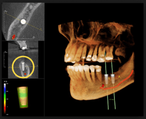 dental implant xray