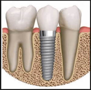 comparing dental implants