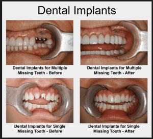 tooth implant prep