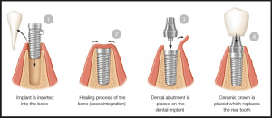 how dental implants work