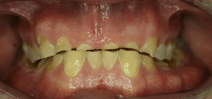 teeth grinding signs